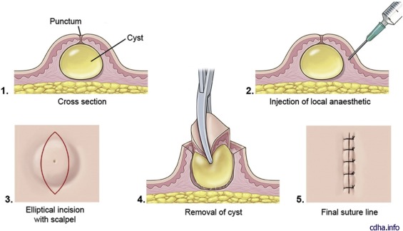 Epidermal cyst resection1